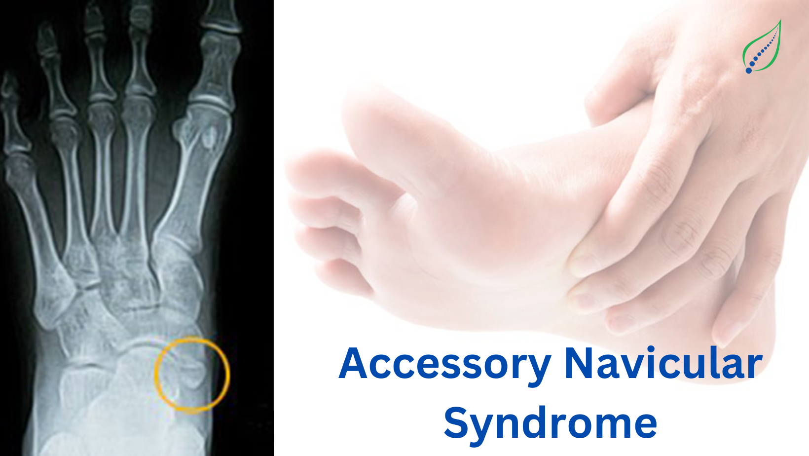 Accessory Navicular Bone
